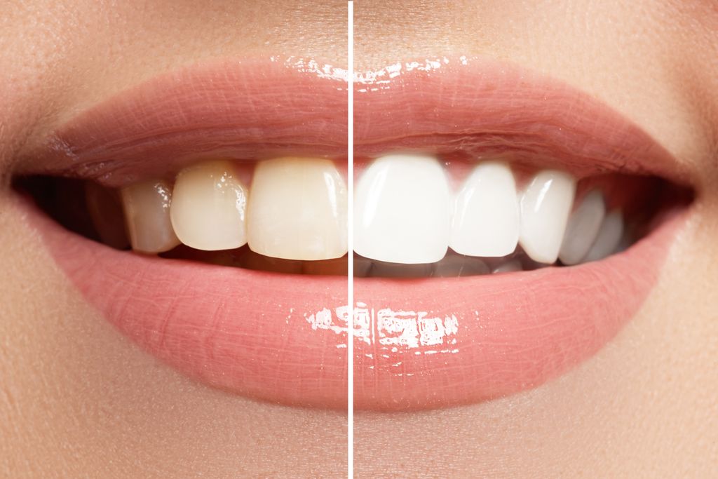 Teeth Whitening Trinidad Guardian
