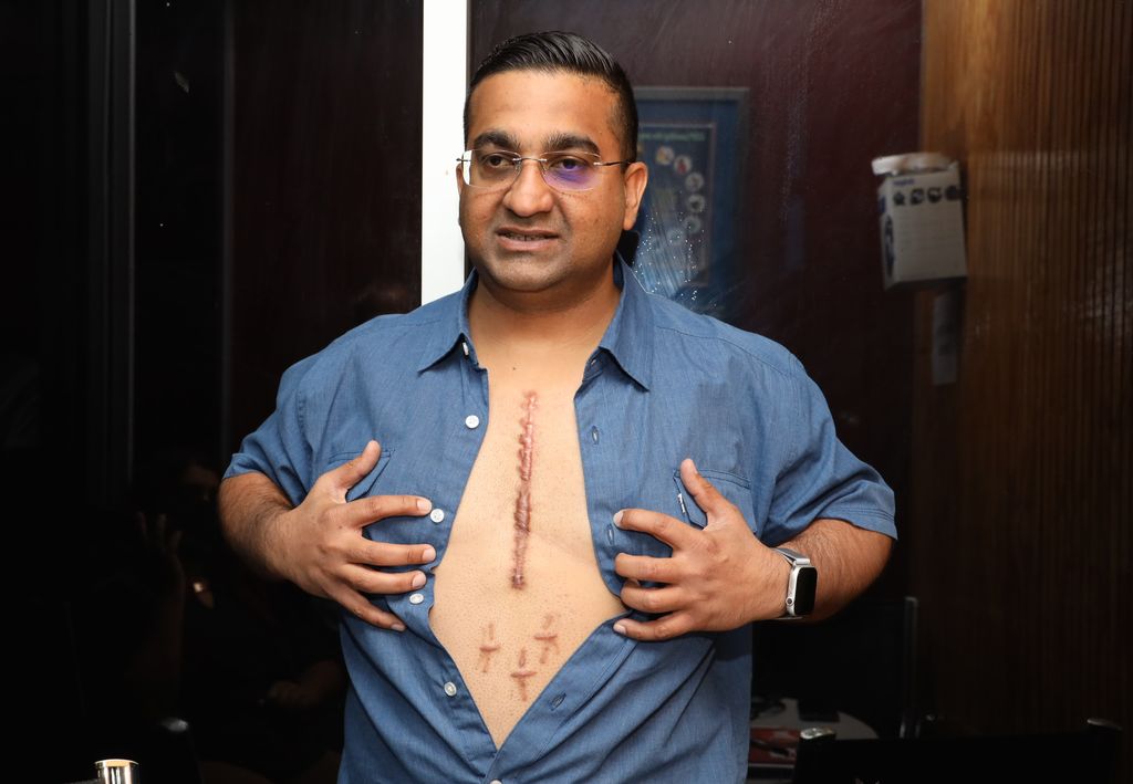 Heart attack survivor Shaun Manocha shows the scars from his surgeries.