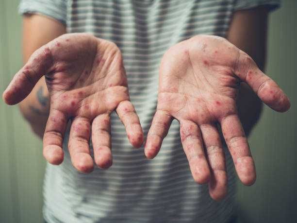 Tobago schools report hand, foot and mouth disease outbreak - Trinidad ...